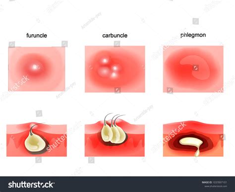Carbuncle Vs Furuncle