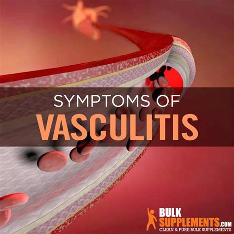 Vasculitis: Symptoms, Causes & Treatment