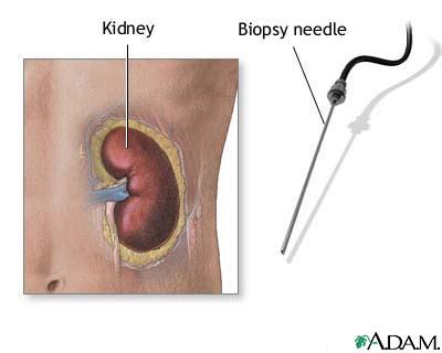 Renal biopsy: MedlinePlus Medical Encyclopedia Image