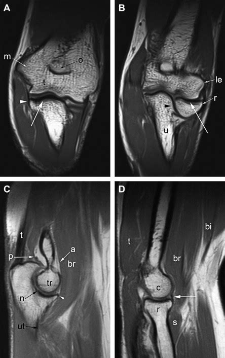 Normal and Variant Anatomy of the Elbow on Magnetic Resonance Imaging ...