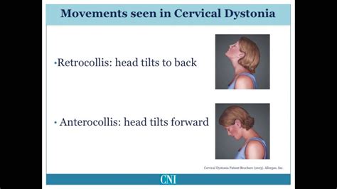 Part 4 - What is Cervical Dystonia? - YouTube