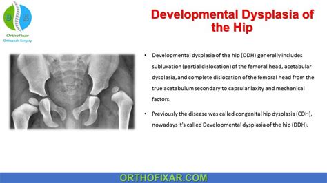 Developmental Dysplasia Of The Hip | OrthoFixar 2024