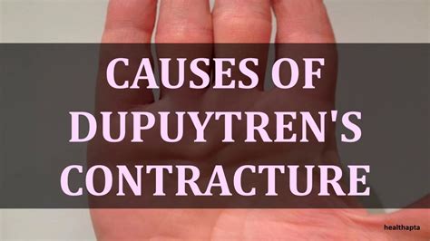 CAUSES OF DUPUYTREN'S CONTRACTURE - YouTube