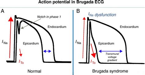 Brugada Syndrome - Causes, ECG, Symptoms, Treatment