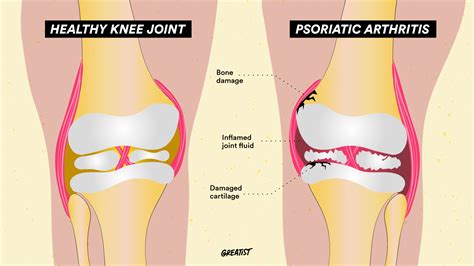 Psoriasis Knee