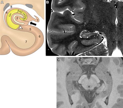 Hippocampus Anatomy Mri