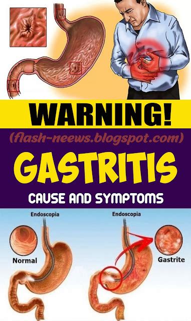 Gastritis – causes and side effects