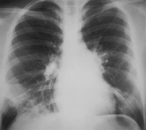 Mycoplasma pneumoniae Pneumonia Radiographic and High-Resolution CT Features in 28 Patients | AJR