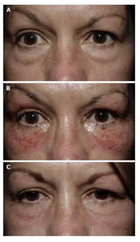 Review of laser and light therapy in the treatment of oculofacial pathology