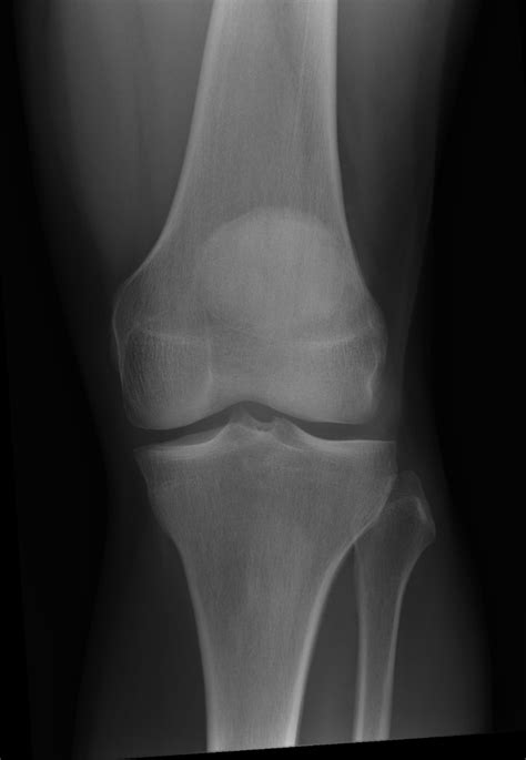 NORMAL KNEE | Buyxraysonline