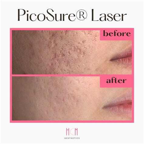 Stunning Removal of Acne Scars With PicoSure Laser Treatment in Houston ...