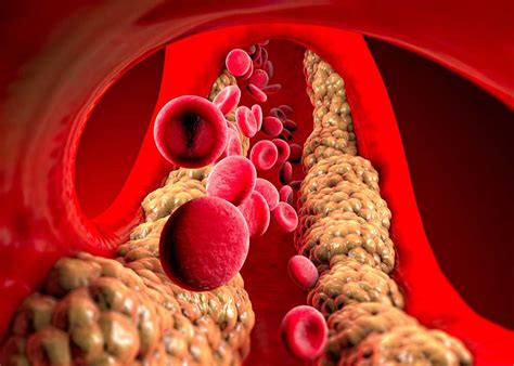 Understanding and Managing High Triglycerides - ENCORE Research Group