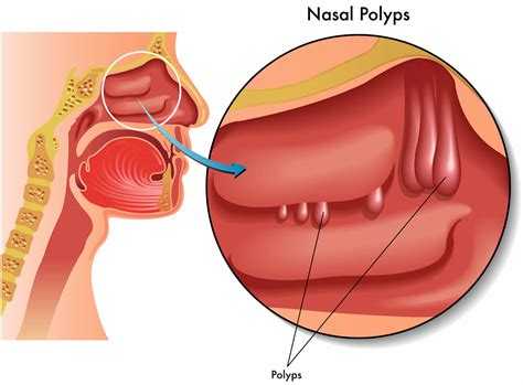 Nasal Polyps - Causes, Symptoms, Home Remedies,Treatment