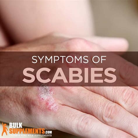 Scabies: Symptoms, Causes & Treatment