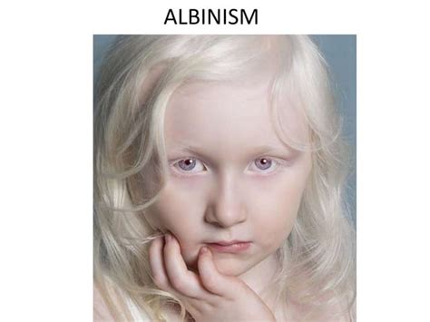 Albinism | PPT