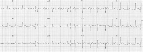 Pericarditis ECG Changes • LITFL • ECG Library Diagnosis