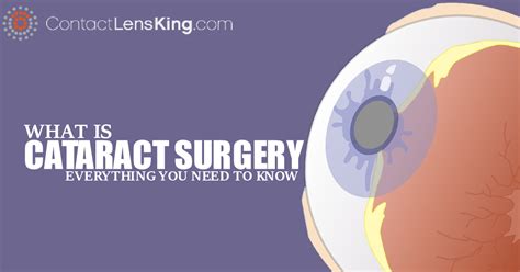 Cataracts Surgery: Things You Should Know - Contact Lens King Blog