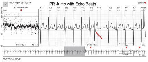 AV Reentrant Tachycardia Case Studies-REVIEW | BardyDx