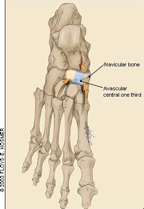 Tarsal Navicular Stress Fractures | AAFP