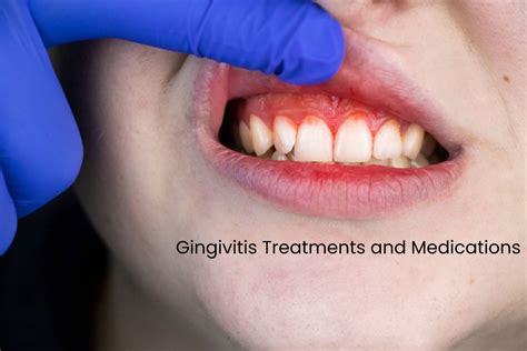 Gingivitis Treatments and Medications