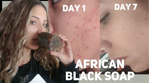 African Soap For Acne