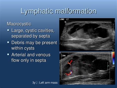 Ultrasound of Vascular anomalies by Oscar M. Navarro