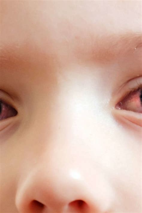 Pink eye in toddlers: Symptoms, diagnosis, and treatment