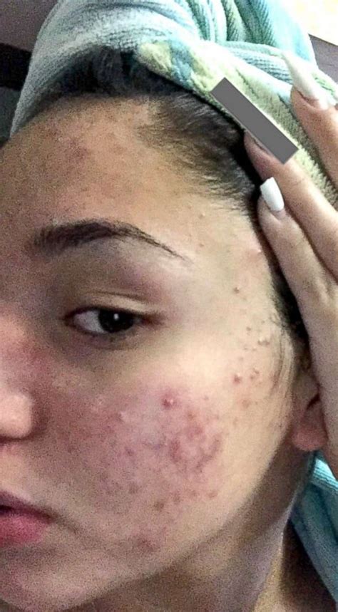 Teen shares how she cleared her severe acne using cheap products - Good ...