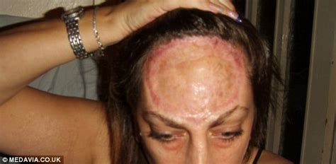 Woman with rare cancer has 85% of her FOREHEAD removed | Daily Mail Online