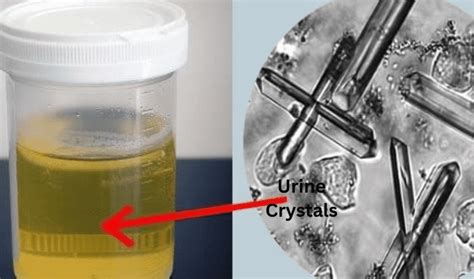 Crystals in Urine | Find out What Causes This, The Symptoms, Treatments ...