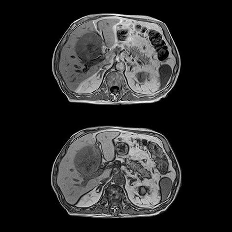 Mri Vs Ct Scan Abdomen