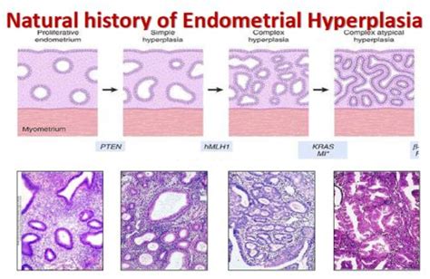 Endometrial hyperplasia | Endometrial hyperplasia, Simple, Medicine