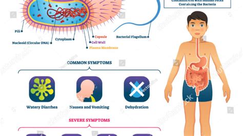 Cholera: Causes, Symptoms and Treatment - Public Health Notes