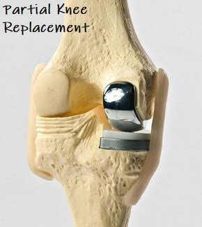 Partial Knee Replacement: Indications, Surgery & Recovery