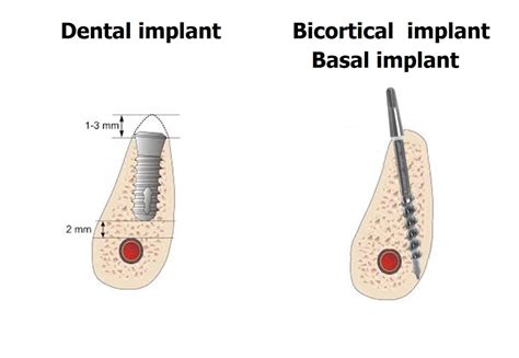 What are Bicortical dental implants or Basal implants | News | Dentagama