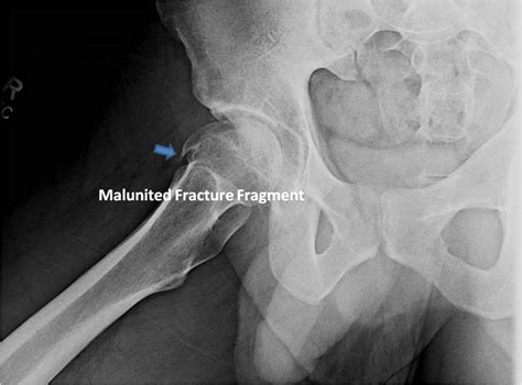 Surgical dislocation for FAI after femoral head fracture malunion in an active young male | St ...