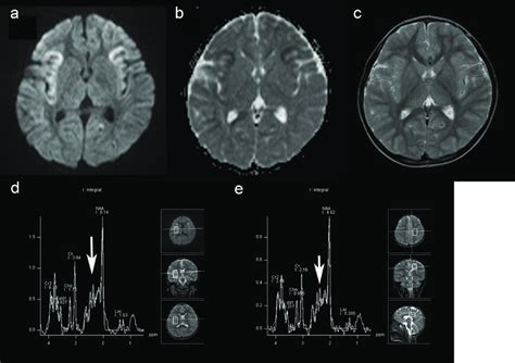 Scalloped ribbon pattern of injury to the depth of the sulcus in the ...