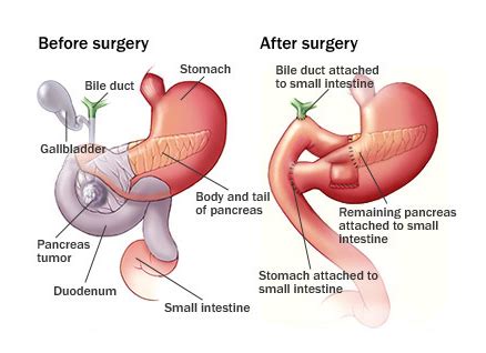 Low Cost Laparoscopic whipples Surgery in India | Affordable whipples ...