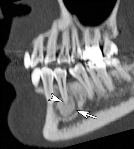 Practical Approach to Radiopaque Jaw Lesions | RadioGraphics