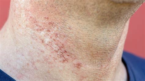 What to Know About Laser Hair Removal Burns