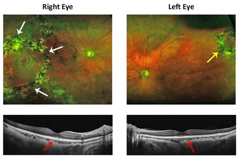 Stickler Syndrome - The Retina Reference