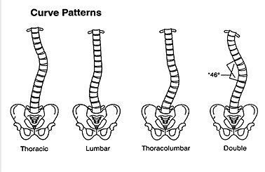 Scoliosis curves Yoga For Scoliosis, Scoliosis Exercises, Extensor ...