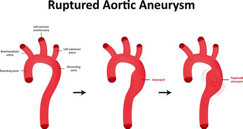 New York Thoracic Aortic Aneurysm, Treatment for Chest Aneurysms | NYC