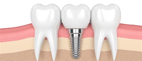 Implant Supported Crowns Montreal, Porcelain Crowns & Bridges, Rue Saint Denis, Plateau Mont-Royal