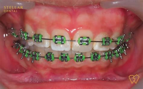 Braces Colors: Top Picks For 2023 - Stellar Dental