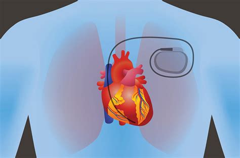 So You Have an Arrhythmia: ICDs and Pacemakers - Penn Medicine