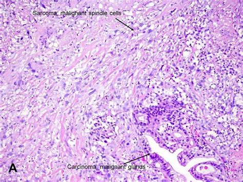 American Urological Association - Sarcomatoid Carcinoma/Carcinosarcoma