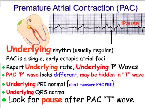 Premature Atrial Contractions Ecg