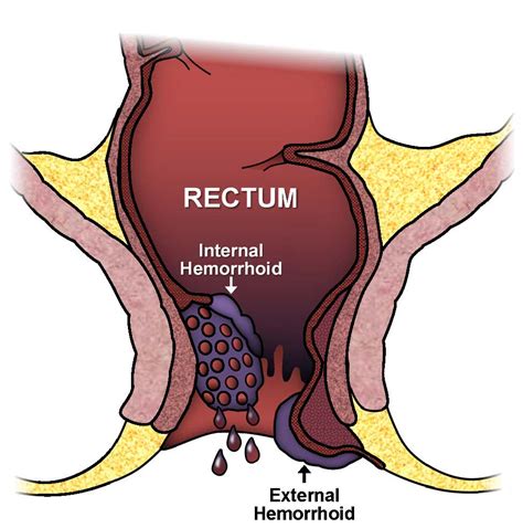 Hemorrhoids: Expanded Version | ASCRS