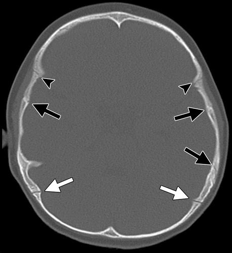 CT of Normal Developmental and Variant Anatomy of the Pediatric Skull: Distinguishing Trauma ...